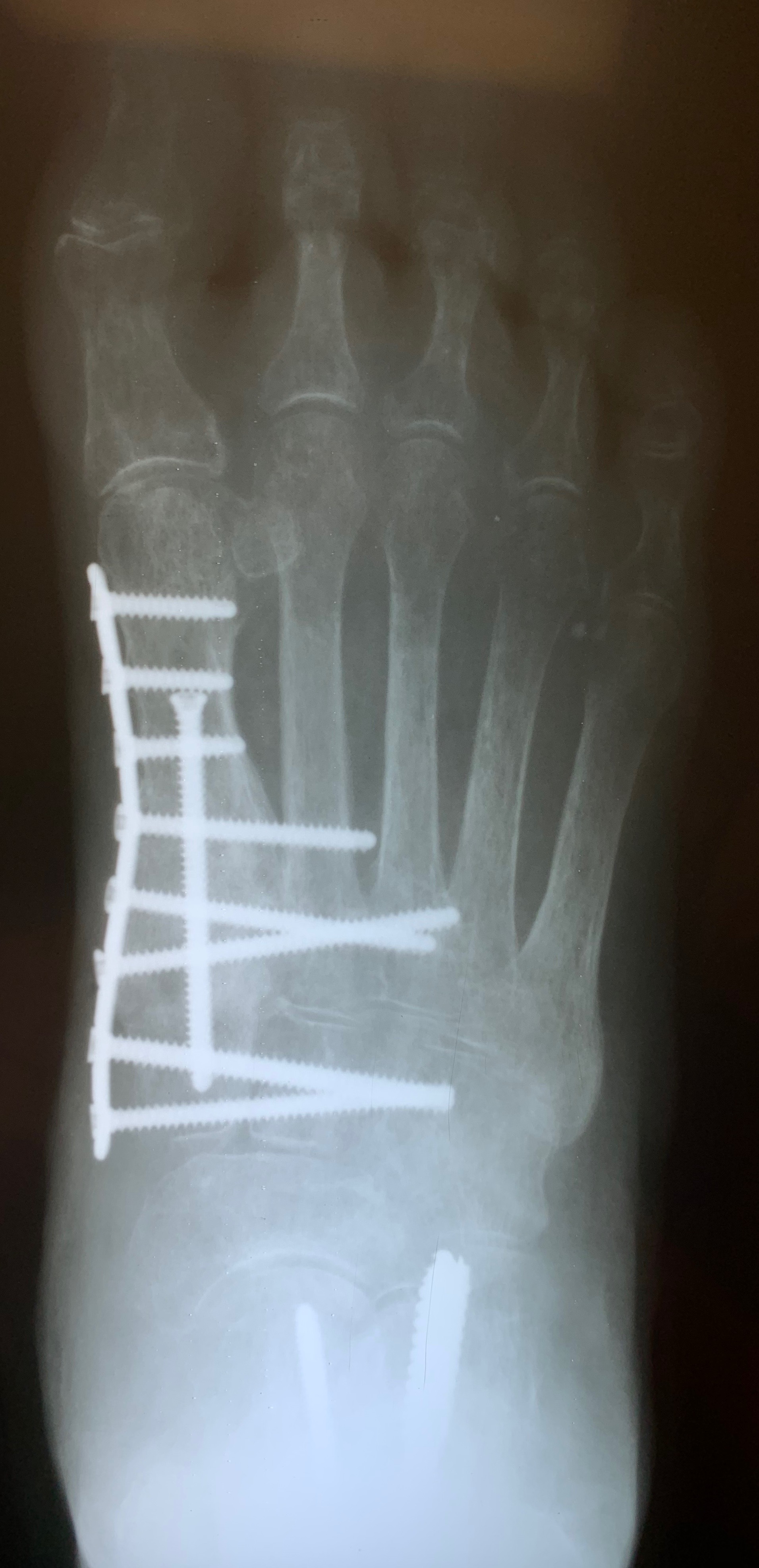 Current Concepts With Autogenous Bone Grafting
